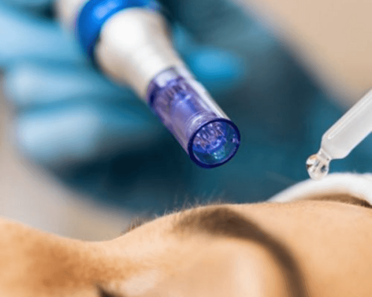 Dermapen cosmetológico facial