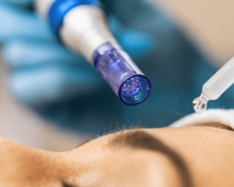 Plasma rico en plaquetas facial