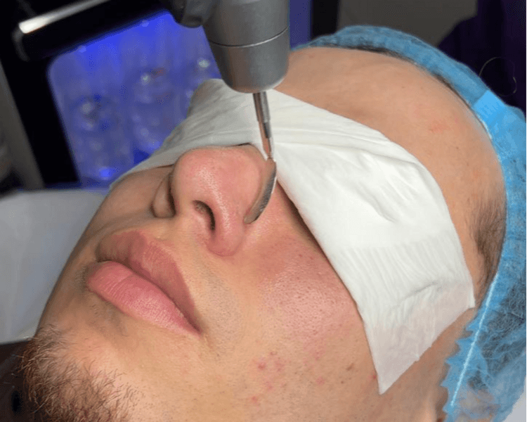 Limpieza Hydrafacial