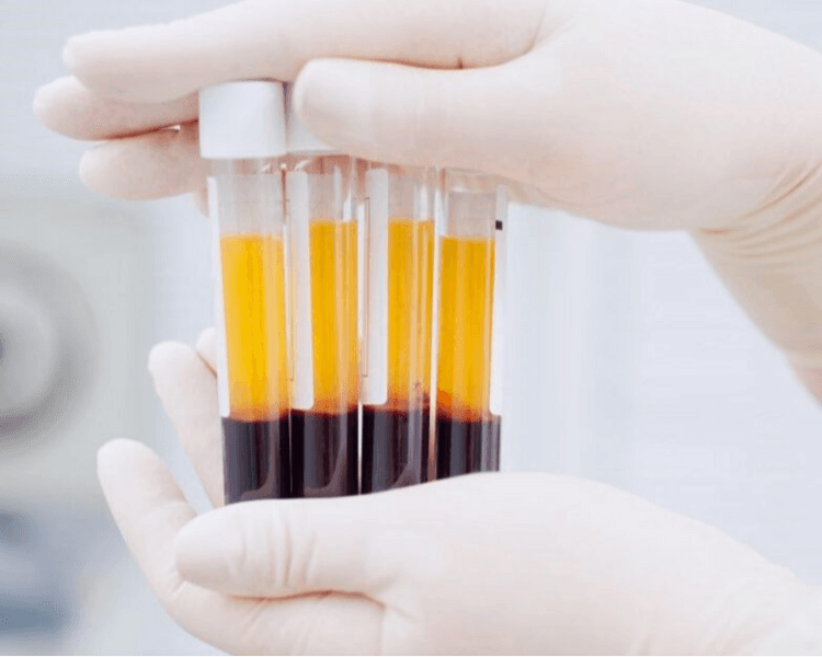 PLASMA RICO EN PLAQUETAS FACIAL Y/O CAPILAR