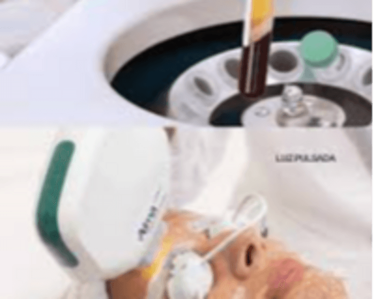 LUZ PULSADA + PLASMA RICO EN PLAQUETAS