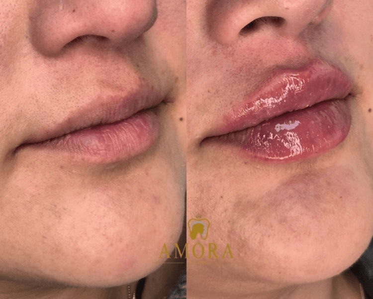 Labiomodelación – $200.000 (M. Hyafilia)/ $260.000 (M. Juvederm)