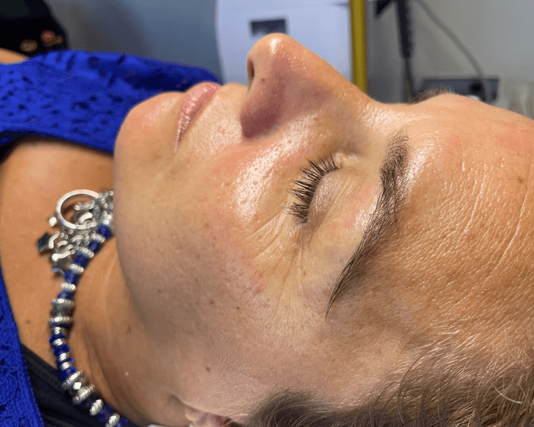 SKIN RENEWAL Limpieza profunda + Microneedling con activos importados