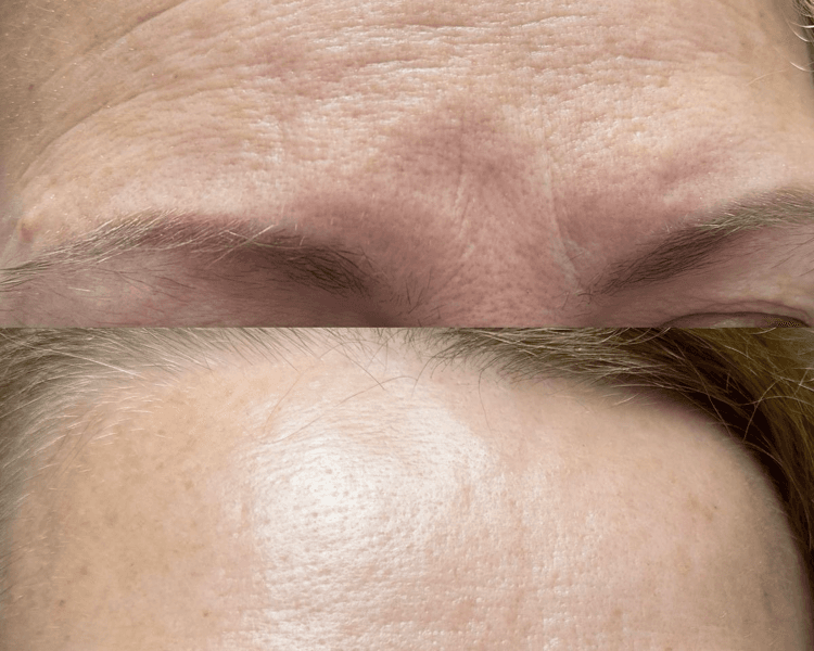 DERMAPEN+EXILIS360 x 6 sesiones