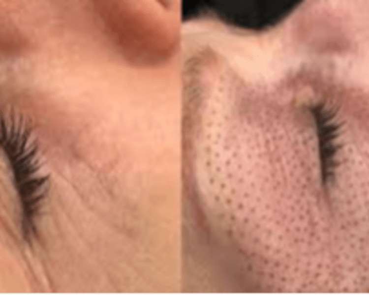 Jato de plasma tercio superior