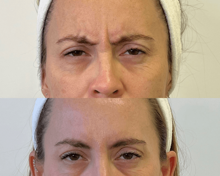 Toxina tercio superior