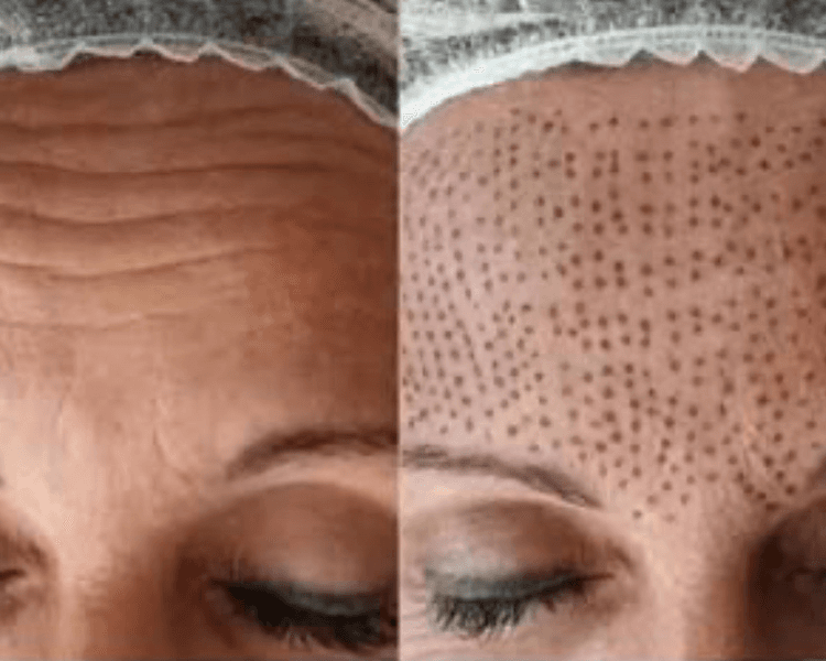 Fibroblast en frente