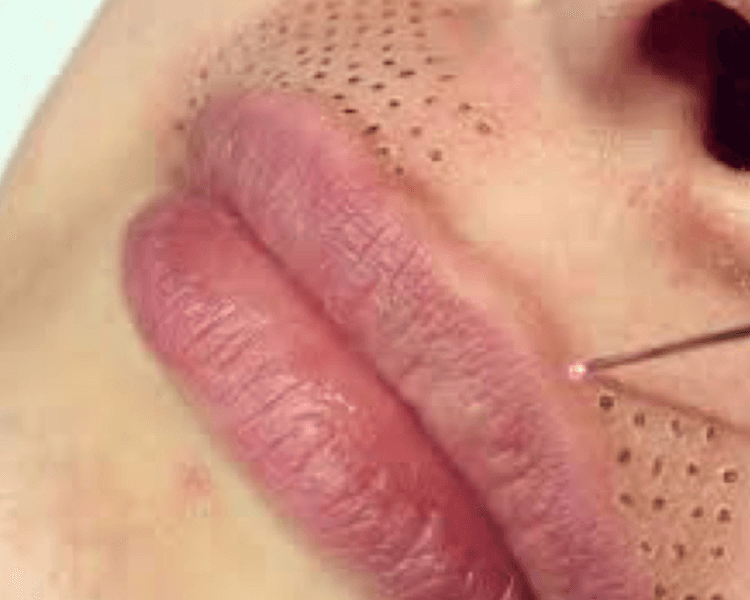 Fibroblast contorno de labios