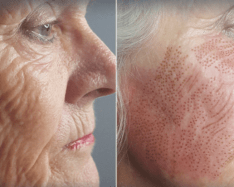 Fibroblast rostro completo