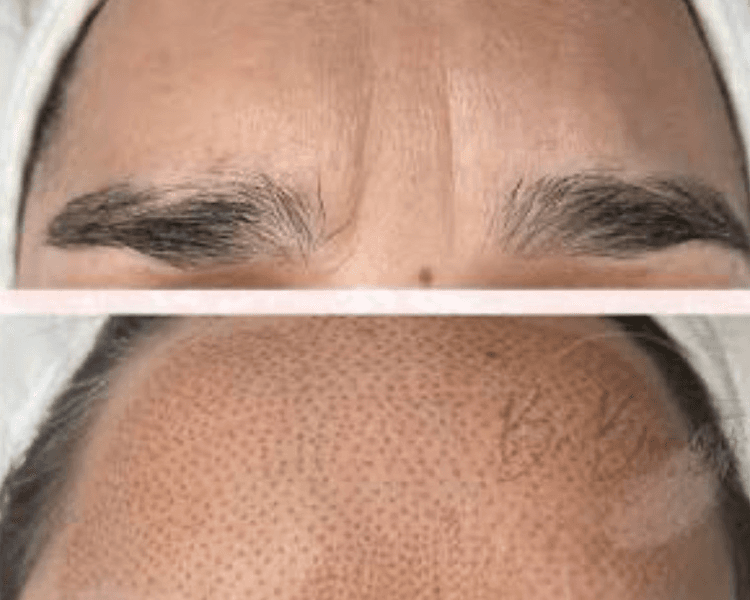 Fibroblast entrecejo