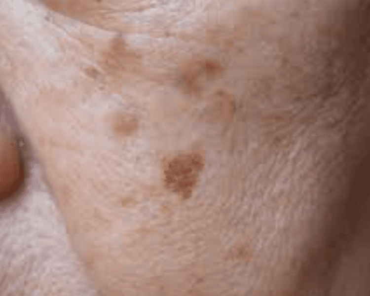 Sesión lentigo rostro (1 mancha)