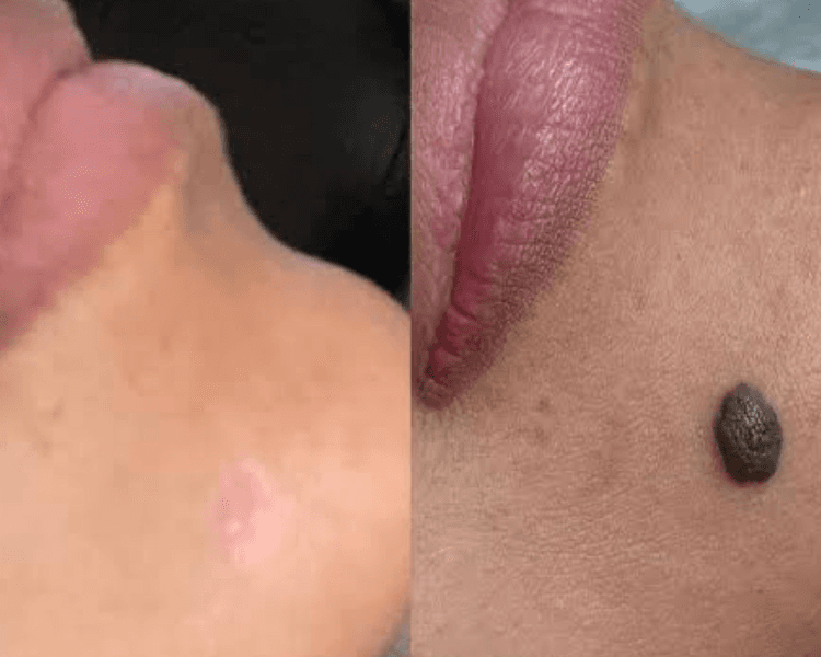 Eliminación 1 lunar de carne