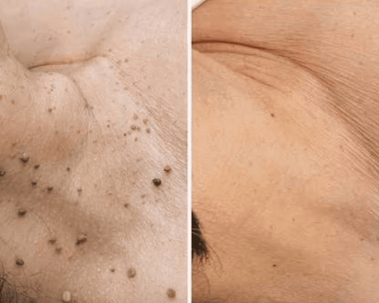 Eliminación acrocordones cuello