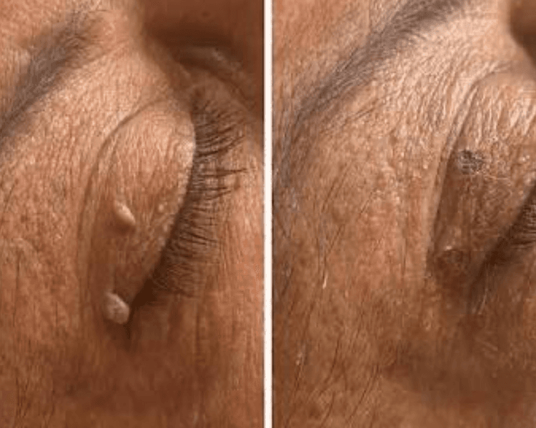 Eliminación 1 verruga facial