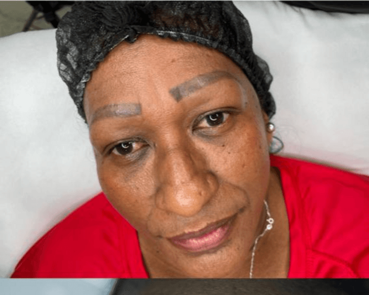 SESION REMOCIÓN LÁSER