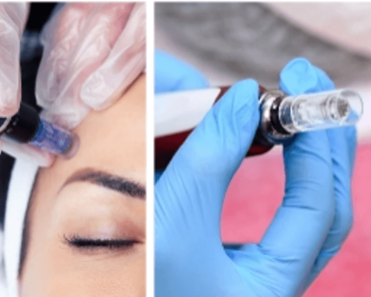 Cóctel de vitaminas con dermapen