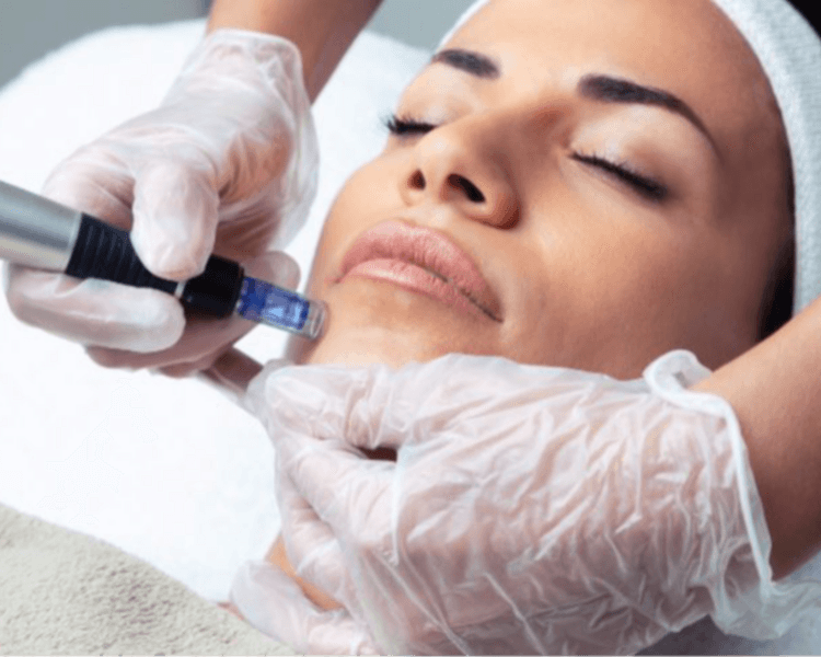 Microneedling de Precisión (Dermapen)