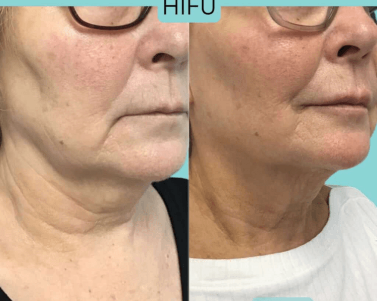 Lifting EMS Facial Pro · Programa 6 sesiones