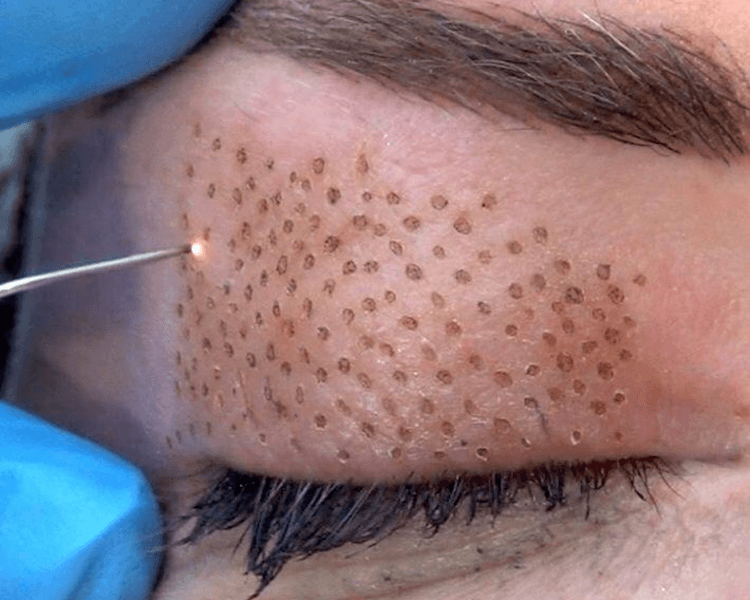 Plasma Pen · Contorno de Ojos Completo