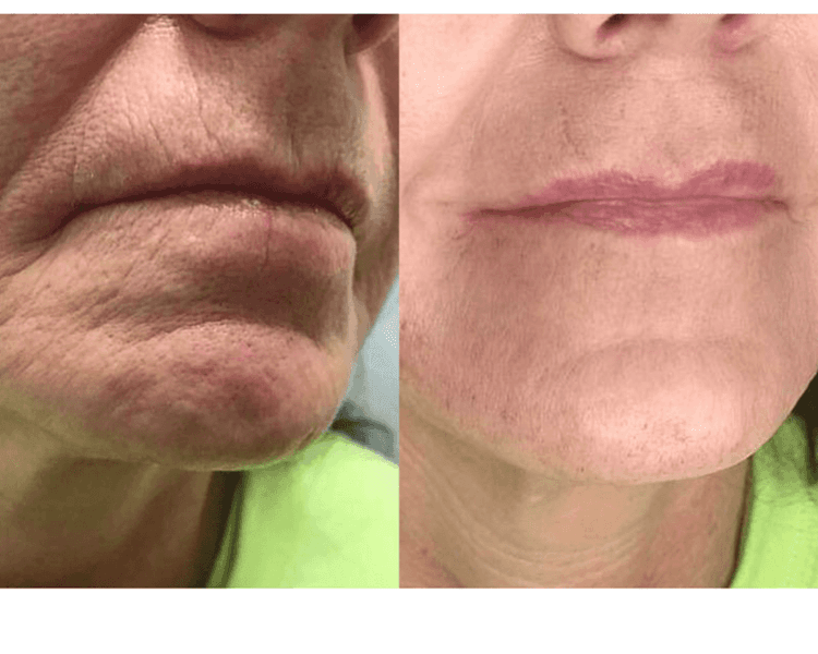 Plasma Pen · Arrugas Periorales