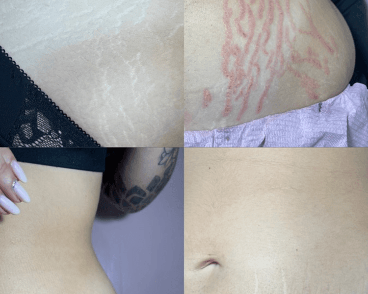 Camuflaje de estrías