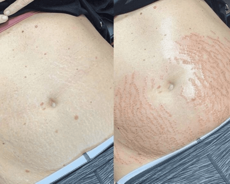 Plasma Pen · Estrías y Cicatrices