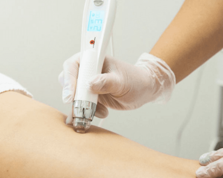 Dermapen Corporal · Estrías y Cicatrices