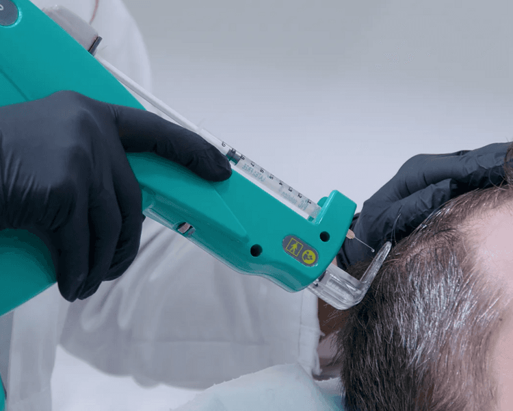 MESOTERAPIA CAPILAR - PARTICULAR