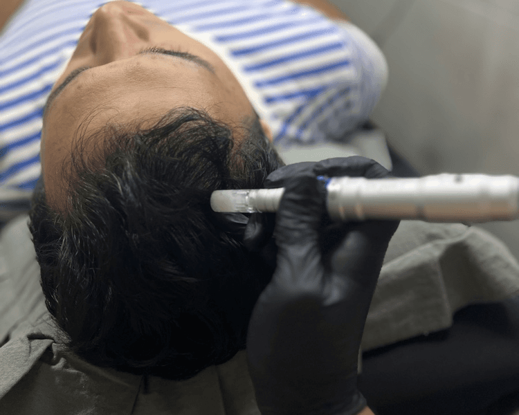 microneedling capilar