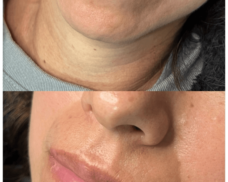 HIDRALIPS (Hidratación de Labios)