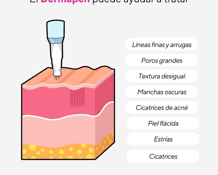 Microneedling cosmiatrico (Limpieza facial con dermapen según biotopo cutánea y objetivos personalizados)
