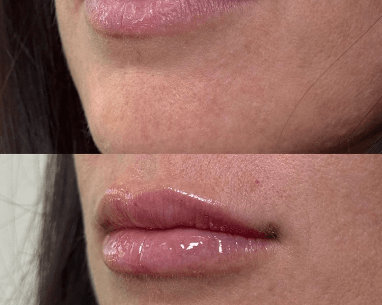 Hidralips con Ácido Hialurónico