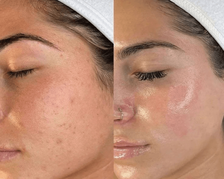 PACK FRAX FACE X5 SESIONES