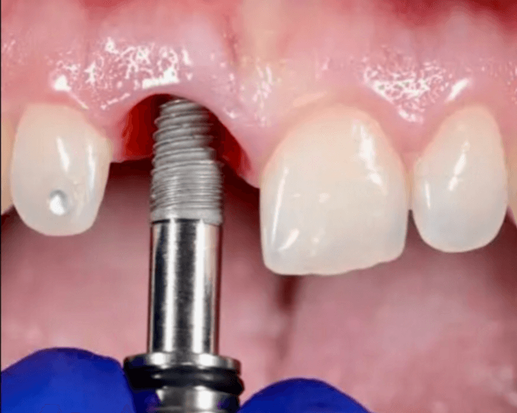 Consulta especialidad Periodoncia - Diagnóstico, evaluación, plan de tratamiento y presupuesto