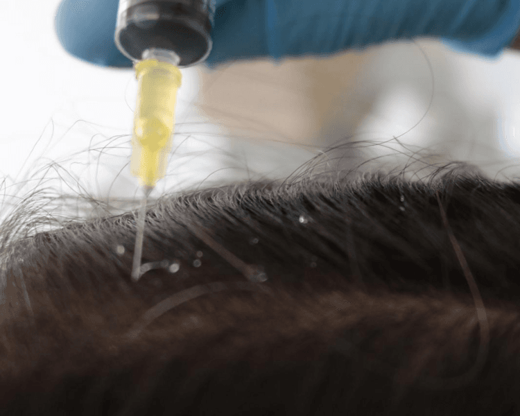 Mesoterapia de control