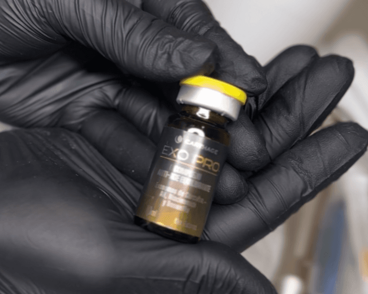 Exosomas con Microneedling