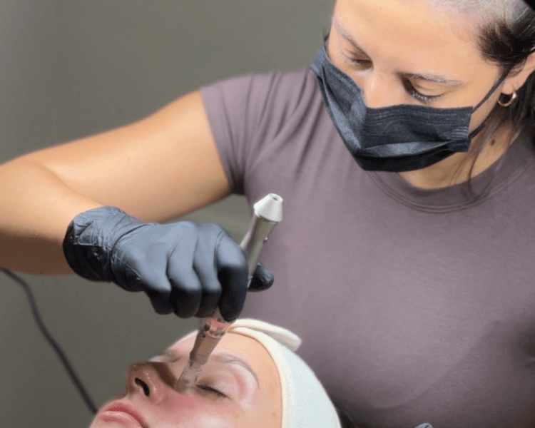 Microneedling