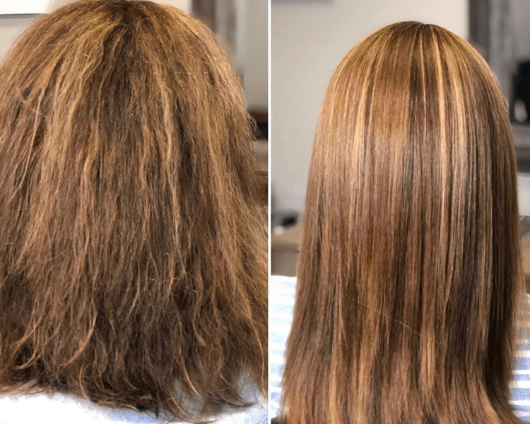 Cirugía Capilar de Truss