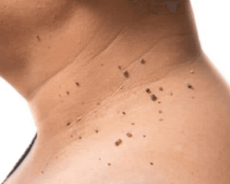 Retiro de Acrocordones