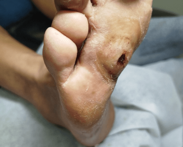 ATENCION PODOLÓGÍCA Gabriela Poujardieu - Todas las patologías: UÑA ENCARNADA, PIE DIABETICO, VERRUGAS, Y MÁS ( SEÑAR EL TURNO 48 HS ANTES al alias: mejoramostuandar)