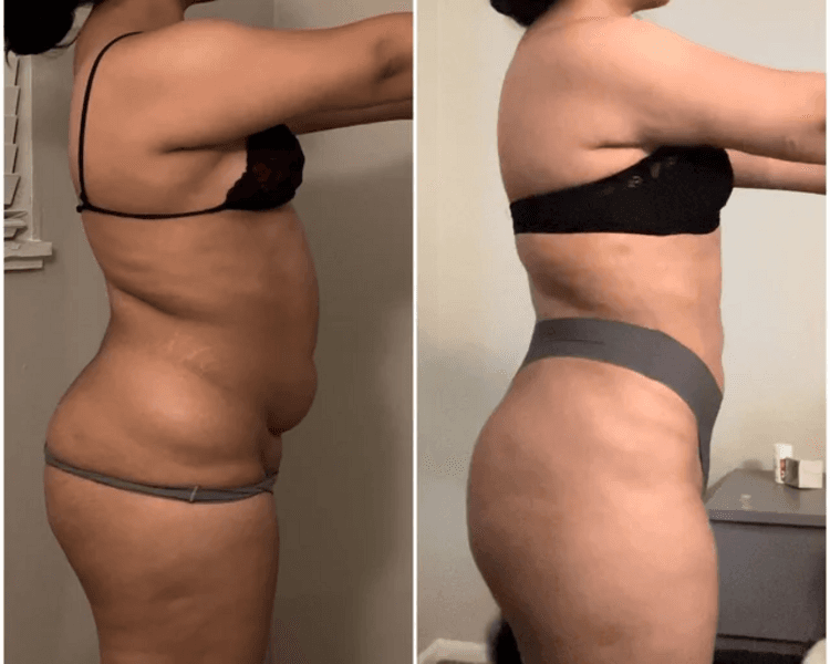 Post-Operatorio Lioposuccion