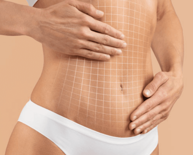 Post-Operatorio Abdominoplastia