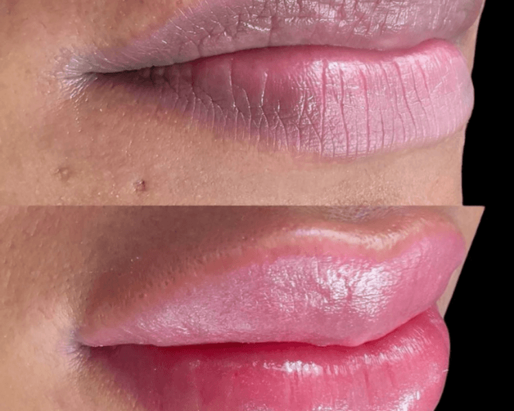 Corrección labial