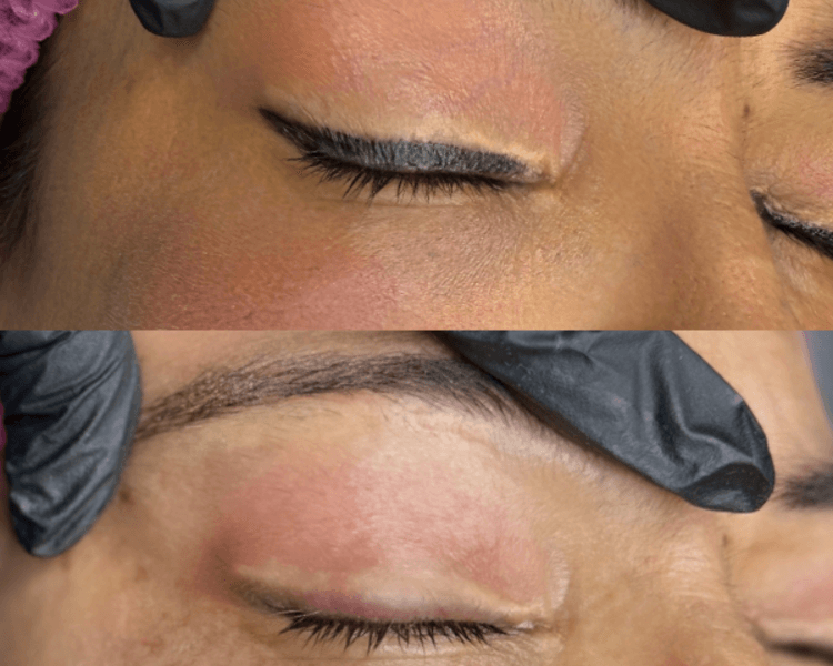 Corrección con láser (por sesión)