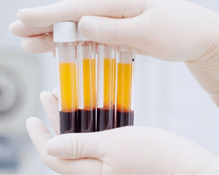 Plasma Rico en Plaquetas corporal (una zona)