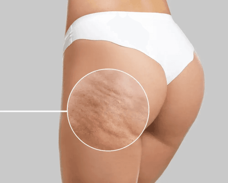 Tratamiento Anticelulitis Premium