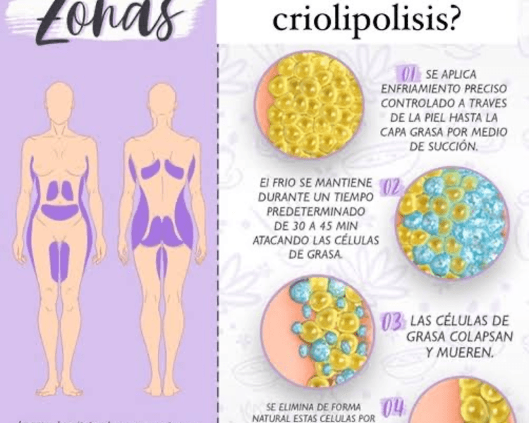 Reductivo Criolipolisis pack 10 sesiones