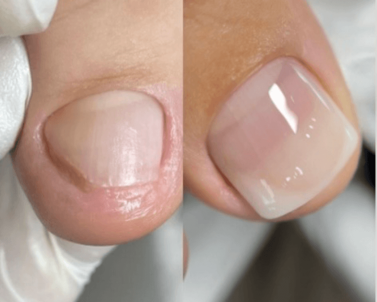 Onicoplastia grado 1 servicio enfocado solo en uñas