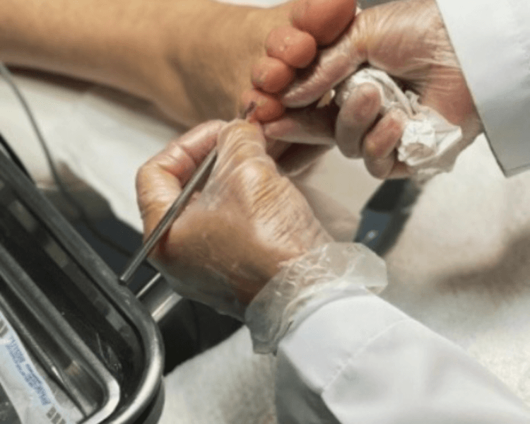 Onicoplastia grado 1 servicio enfocado en uñas y talones