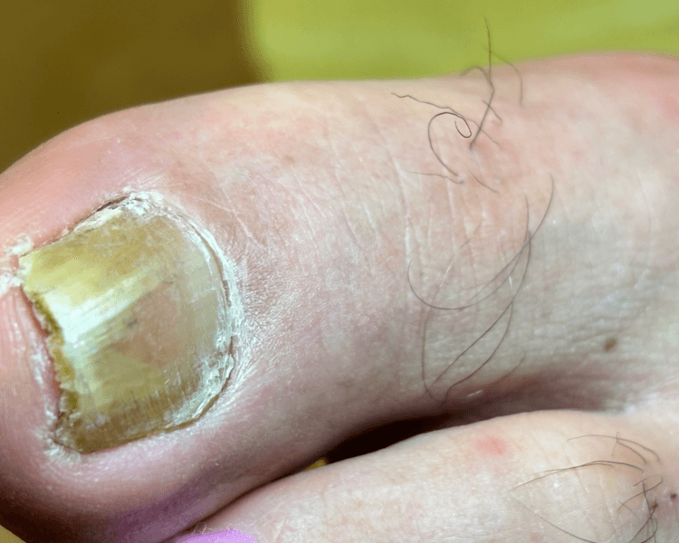 Quiropodia Onicomicosis